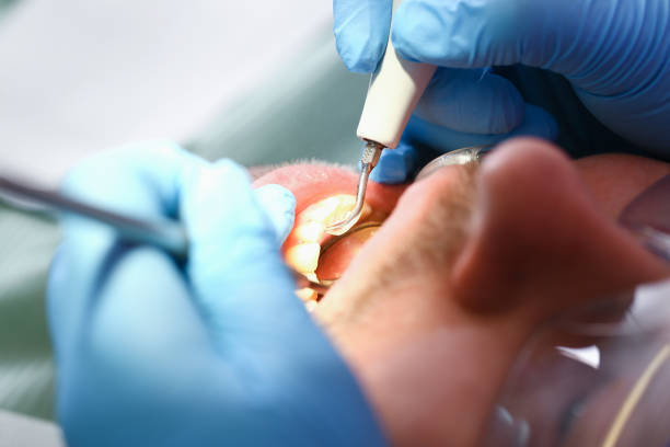 Best Emergency Treatment for Oral Infections in Attica, IN